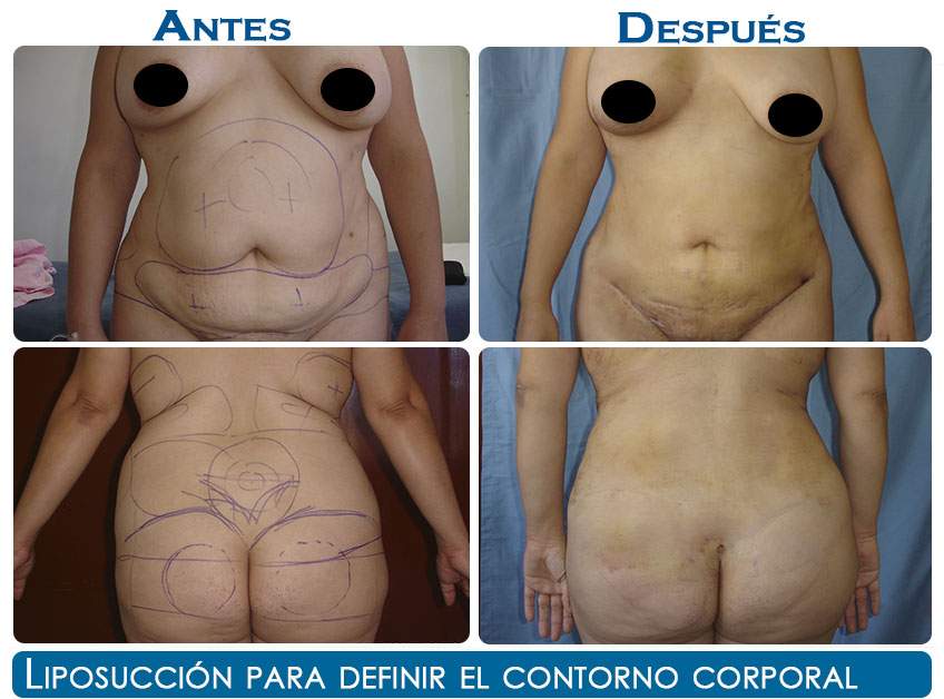 liposuccion-n22-1
