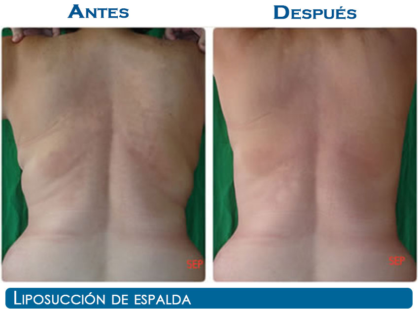 liposuccion-n22-2