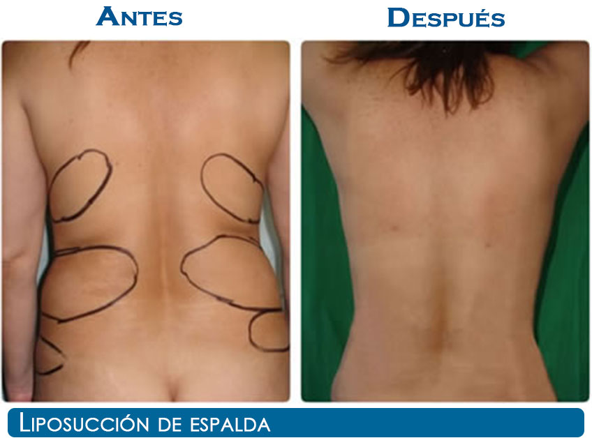 liposuccion-n22-3