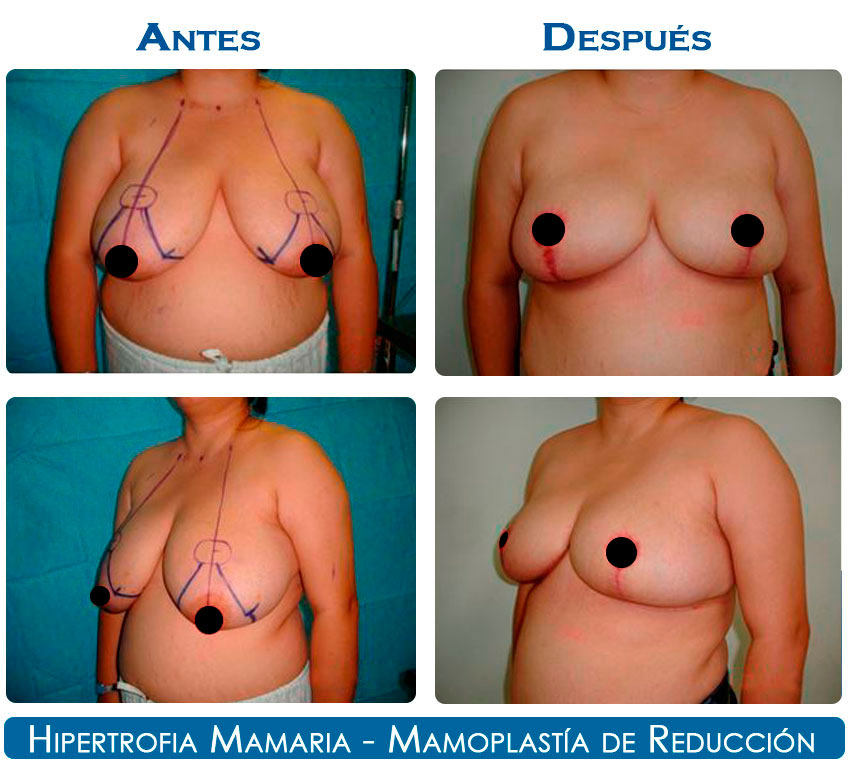 reduccion-2-22