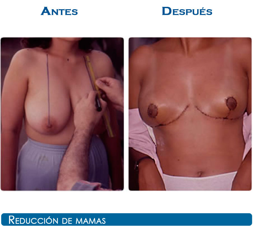 reduccion-3-22