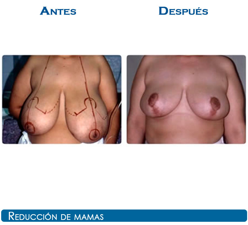 reduccion-4-22