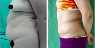 Abdominoplastia