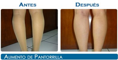 Implante de pantorrillas