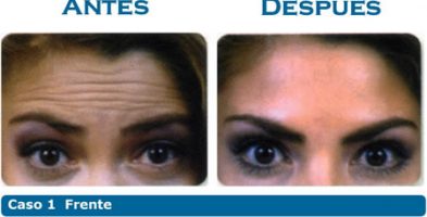 Toxina Botulínica y Materiales de relleno