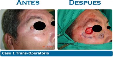 Cáncer facial