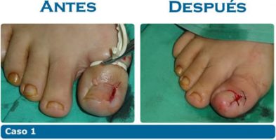 Uñeros