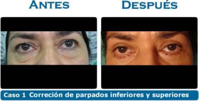 Bleferoplastia