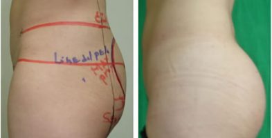 Aumento de gluteos