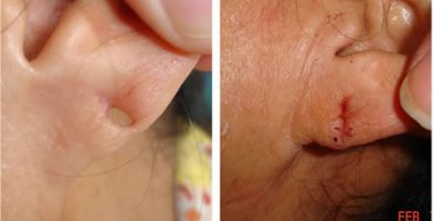 Corrección del Lobulo de Oreja (Arete)