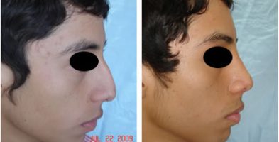 Rinoplastia