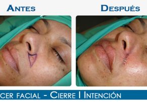 Cáncer Facial- Cierre I Intención
