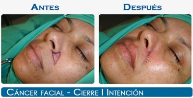 Cáncer Facial- Cierre I Intención