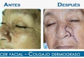 Cáncer Facial – Colgajo Dermograso