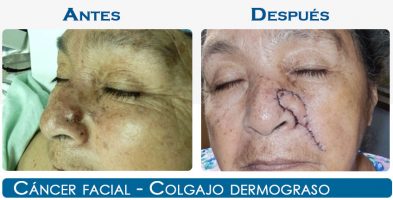 Cáncer Facial – Colgajo Dermograso