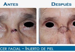 Cáncer Facial – Injerto de Piel