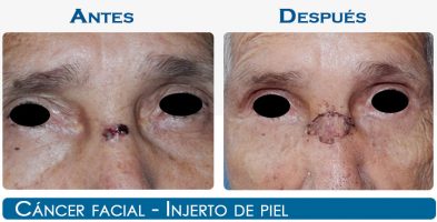 Cáncer Facial – Injerto de Piel