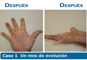 Dupuytren