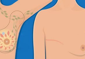 ¿Cuando reconstruir una mama?