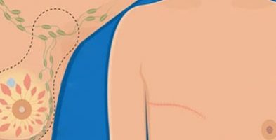 ¿Cuando reconstruir una mama?