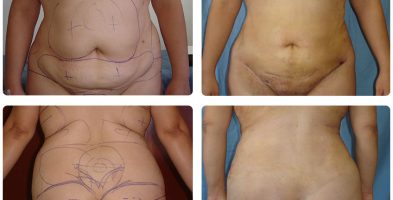Lipoescultura
