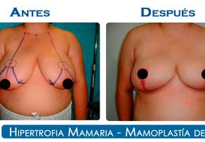 Reduccion de mamas