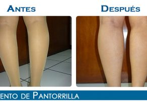Implante de pantorrillas