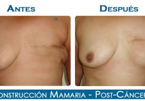 Reconstrucción Mamaria