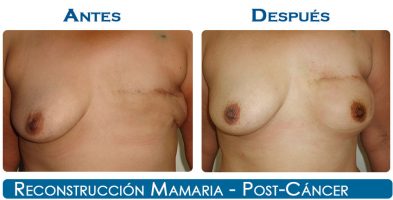 Reconstrucción Mamaria